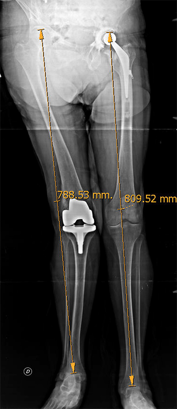 Comportamiento de la infección periprotésica de rodilla